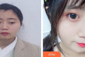 郴州市第一人民醫(yī)院整形美容科張安利整形價格表附鼻部綜合案例展示