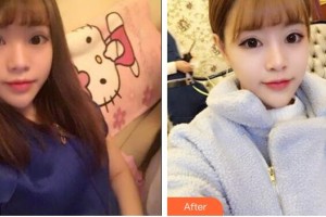 郴州市第一人民醫(yī)院整形美容科胡永才整形價格表附鼻部綜合案例展示