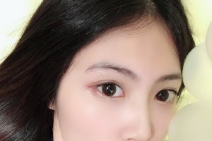 西京醫(yī)院整形外科怎么樣？隆鼻手術(shù)附果圖