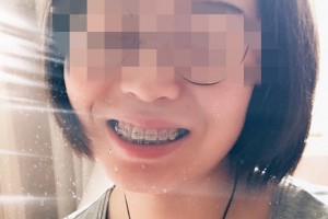 南京市口腔醫(yī)院牙齒矯正果？術(shù)后經(jīng)驗(yàn)分享