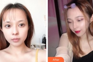 郴州瑞瀾醫(yī)療美容醫(yī)院謝靚整形價格表附微針美膚案例展示