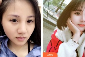 郴州市第四人民醫(yī)院王飛整形價格表附鼻部綜合案例展示