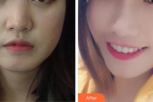 郴州市第四人民醫(yī)院余永斌整形價格表附埋線提升案例展示