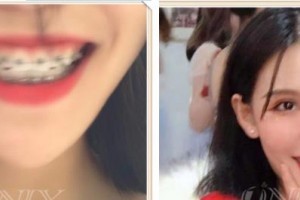 郴州冠華口腔醫(yī)院葛旭明整形價(jià)格表附金屬托槽矯正案例展示