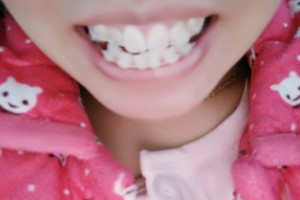 南昌輝煌口腔醫(yī)院彭凡牙齒矯正+圖片對比|較新價格表