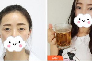 佛山華廈眼科醫(yī)院張廣斌整形價(jià)格表附切開雙眼皮案例展示