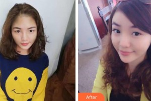 佛山華廈眼科醫(yī)院吳國基整形價(jià)格表附切開雙眼皮案例展示