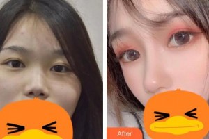 佛山華廈眼科醫(yī)院吳護(hù)平整形價(jià)格表附切開雙眼皮案例展示