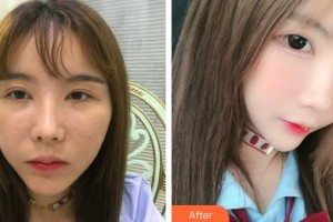 佛山華廈眼科醫(yī)院王騫整形價(jià)格表附眼部整形下眼下至術(shù)案例展示