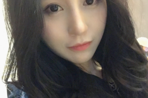 北京大學深圳醫(yī)院整形外科割雙眼皮果好不好附案例分享