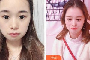 連云港第一人民醫(yī)院燒傷整形科丁祥生整形價格表附眼部綜合案例展示