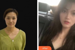 連云港徐楊醫(yī)療美容門診部徐楊整形價格表附眼部綜合案例展示