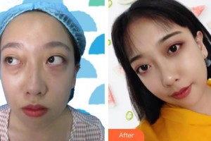 連云港徐楊醫(yī)療美容門診部王莉燕整形價格表附內(nèi)切祛眼袋案例展示