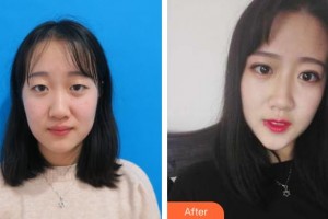 連云港美締整形美容診所李海詩整形價格表附切開雙眼皮案例展示