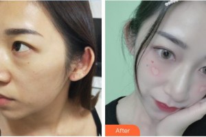 連云港億大整形美容醫(yī)院蘇成勝整形價格表附激光去眼袋案例展示