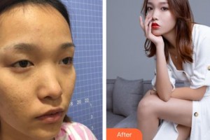 連云港徐楊醫(yī)療美容門診部吳紅波整形價格表附眶隔脂肪釋放案例展示