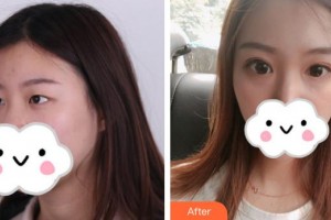 連云港成宏口腔醫(yī)院成宏整形價格表附眼部綜合案例展示