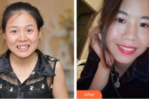 連云港成宏口腔醫(yī)院籍增平整形價格表附自鎖托槽矯正案例展示