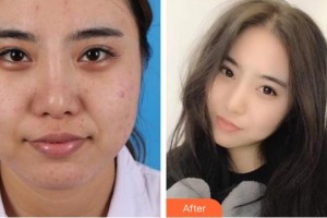 南昌大學(xué)附屬眼科醫(yī)院羅興中整形價格表附眼部綜合案例展示