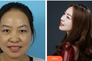 南昌大學(xué)附屬眼科醫(yī)院洪亮整形價格表附眼部綜合案例展示