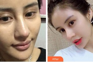 南昌大學(xué)附屬眼科醫(yī)院程先華整形價格表附定點雙眼皮案例展示