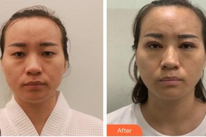 南昌大學(xué)附屬眼科醫(yī)院孫濤整形價格表附切開雙眼皮案例展示