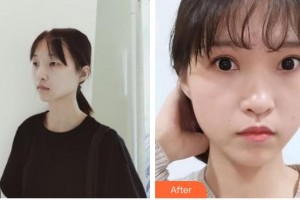 南昌大學(xué)附屬眼科醫(yī)院羅潔整形價格表附切開雙眼皮案例展示