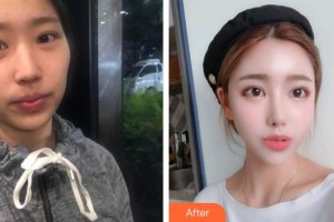 南昌大學(xué)附屬眼科醫(yī)院譚桂英整形價格表附眼部綜合案例展示