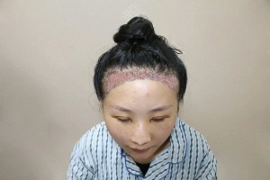 江蘇省常熟市第二人民醫(yī)院哪個(gè)醫(yī)生植發(fā)好附案例和醫(yī)生推薦