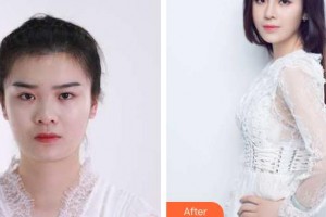 南昌大學(xué)附屬眼科醫(yī)院易路輝整形價格表附眼部綜合案例展示