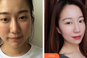 南昌大學(xué)附屬眼科醫(yī)院劉盛濤整形價格表附激光去黑眼圈案例展示