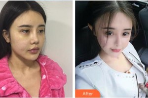 南昌愛視眼科醫(yī)院肖俊華整形價格表附眼部綜合案例展示