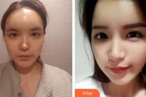 南昌普瑞眼科醫(yī)院田軍整形價格表附切開雙眼皮案例展示