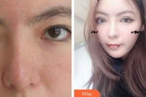 南昌普瑞眼科醫(yī)院高昭輝整形價格表附切開雙眼皮案例展示