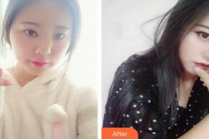 南昌大學(xué)附屬眼科醫(yī)院張超中整形價格表附定點(diǎn)雙眼皮案例展示