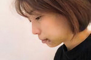 杭州時光醫(yī)療美容醫(yī)院河東鎬磨骨怎么樣?附術后果圖