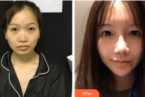 雞西王醫(yī)生整形外科門診部吳政諺整形價格表附鼻部綜合案例展示