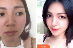 雞西王醫(yī)生整形外科門診部李元整形價格表附鼻部綜合案例展示