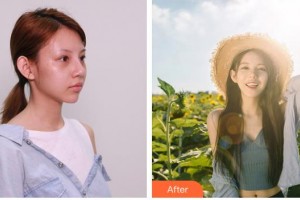 雞西王醫(yī)生整形外科門診部呂睿纮整形價格表附硅膠隆鼻案例展示