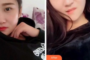 雞西王杰口腔診所王杰整形價格表附根管調節(jié)案例展示