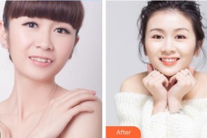 雞西王醫(yī)生整形外科門診部陳添良整形價格表附隱形托槽矯正案例展示