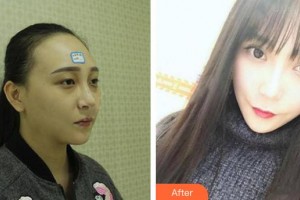 咸陽長城醫(yī)院整形美容中心姚醫(yī)生整形價(jià)格表附眼部修復(fù)案例展示