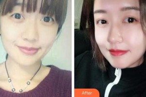 咸陽華爾醫(yī)療美容門診部孫瑞陽整形價(jià)格表附切開雙眼皮案例展示