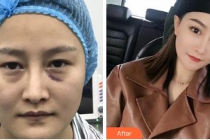 咸陽愛爾眼科醫(yī)院周善文整形價(jià)格表附切開雙眼皮案例展示