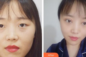 咸陽愛爾眼科醫(yī)院劉雪芳整形價(jià)格表附切開雙眼皮案例展示