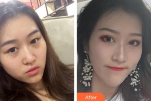 咸陽愛爾眼科醫(yī)院陳小瑾整形價(jià)格表附切開雙眼皮案例展示