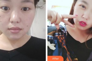 咸陽(yáng)市第一人民醫(yī)院眼科醫(yī)院王升整形價(jià)格表附切開(kāi)雙眼皮案例展示