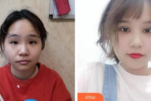 咸陽(yáng)市第一人民醫(yī)院眼科醫(yī)院王敏整形價(jià)格表附眼部綜合案例展示