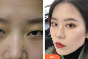 咸陽(yáng)市第一人民醫(yī)院眼科醫(yī)院侯力華整形價(jià)格表附切開(kāi)雙眼皮案例展示