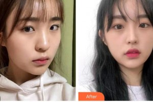 咸陽(yáng)市第一人民醫(yī)院眼科醫(yī)院張少華整形價(jià)格表附眼部綜合案例展示